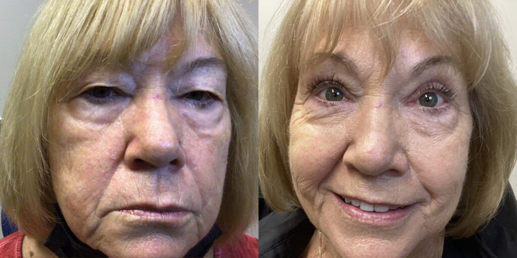 Before & After Upper Eyelids