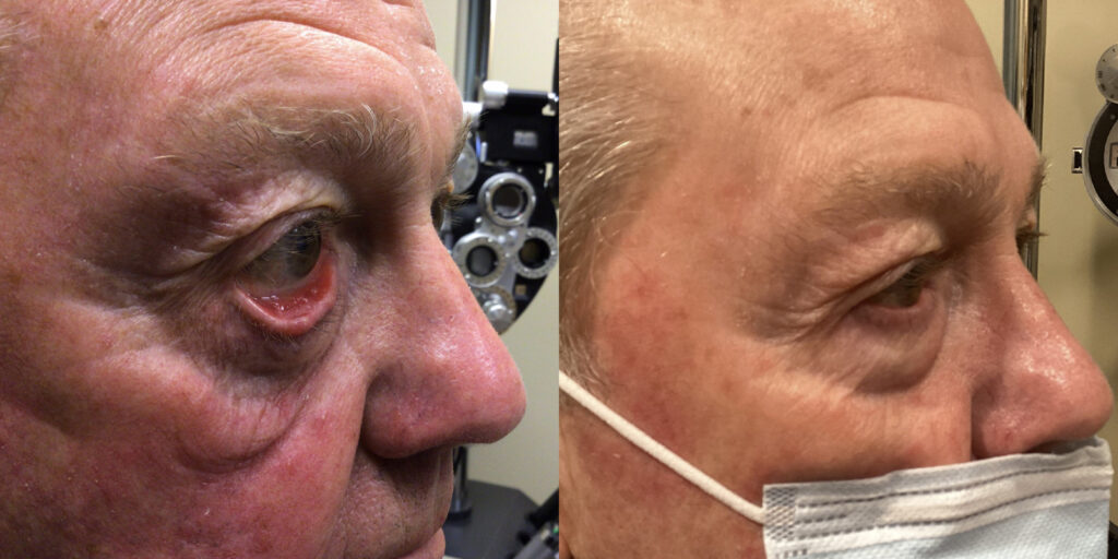 Before and After ectropian repair