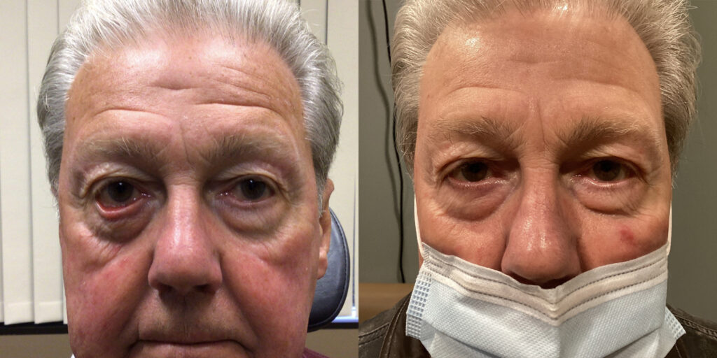Ectropion repair before and after