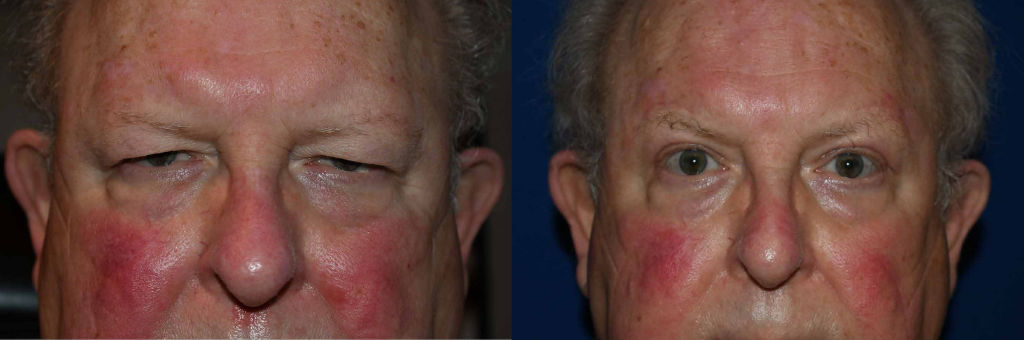 Before and after of eyelid lift