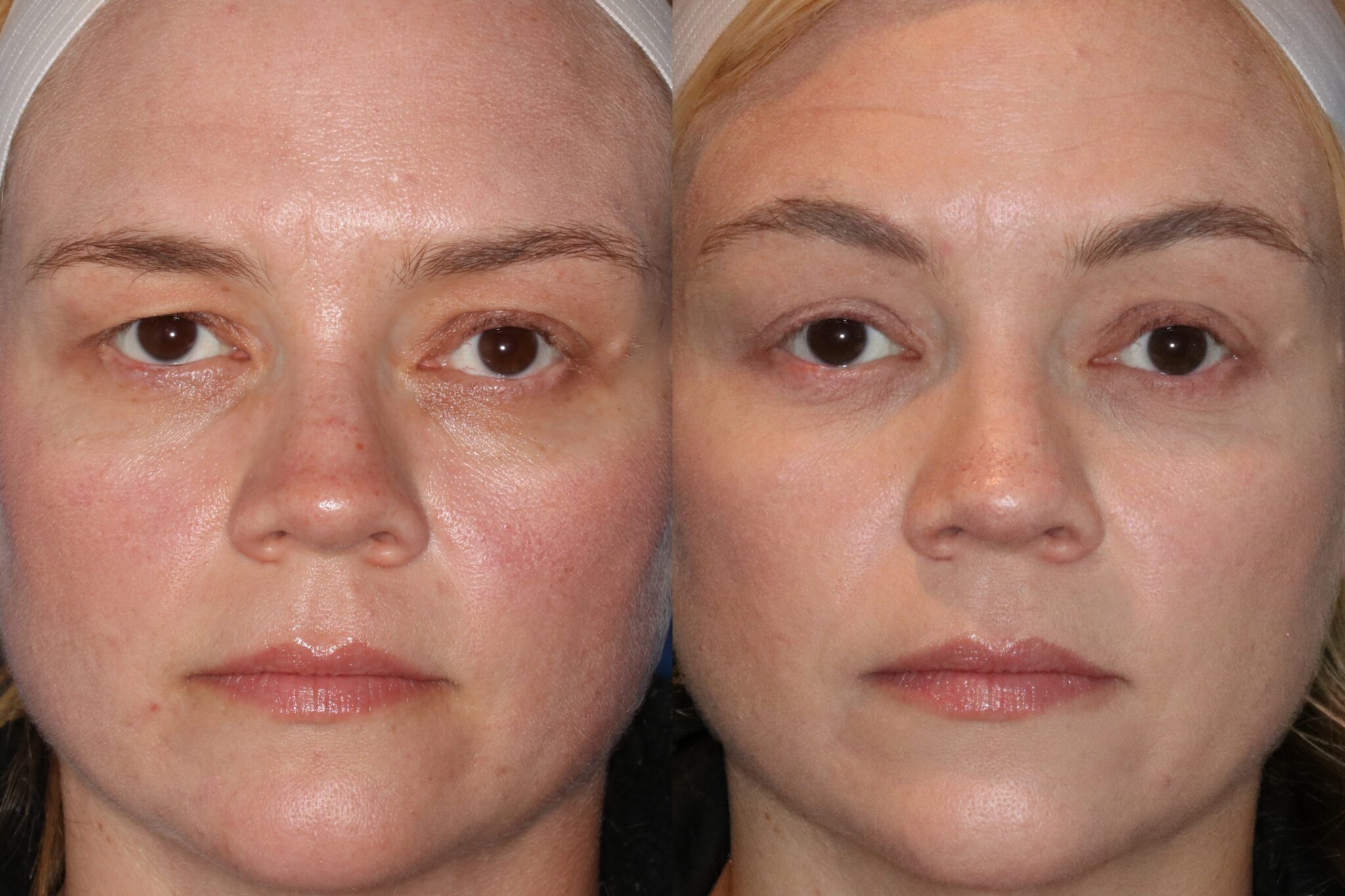 Before & After Photos Eye Health Northwest