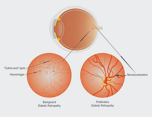 How to Manage Cotton Wool Spots on the Retina