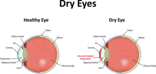 Dry eyes diagrams