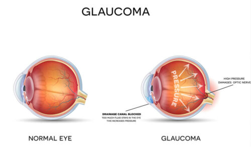 Glaucoma diagram