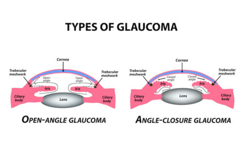 Glaucoma types diagram