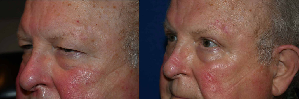 Before and after of eyelid lift