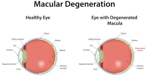 Macular degeneration diagram