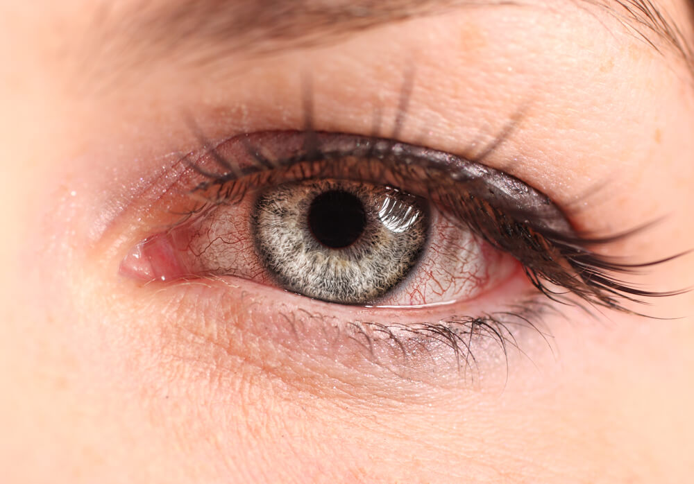 Example of pink eye
