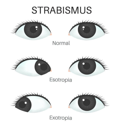 strabismus diagram