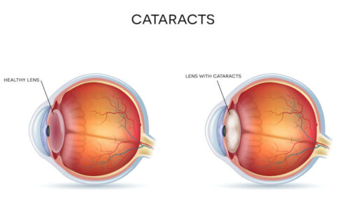 Cataract diagram